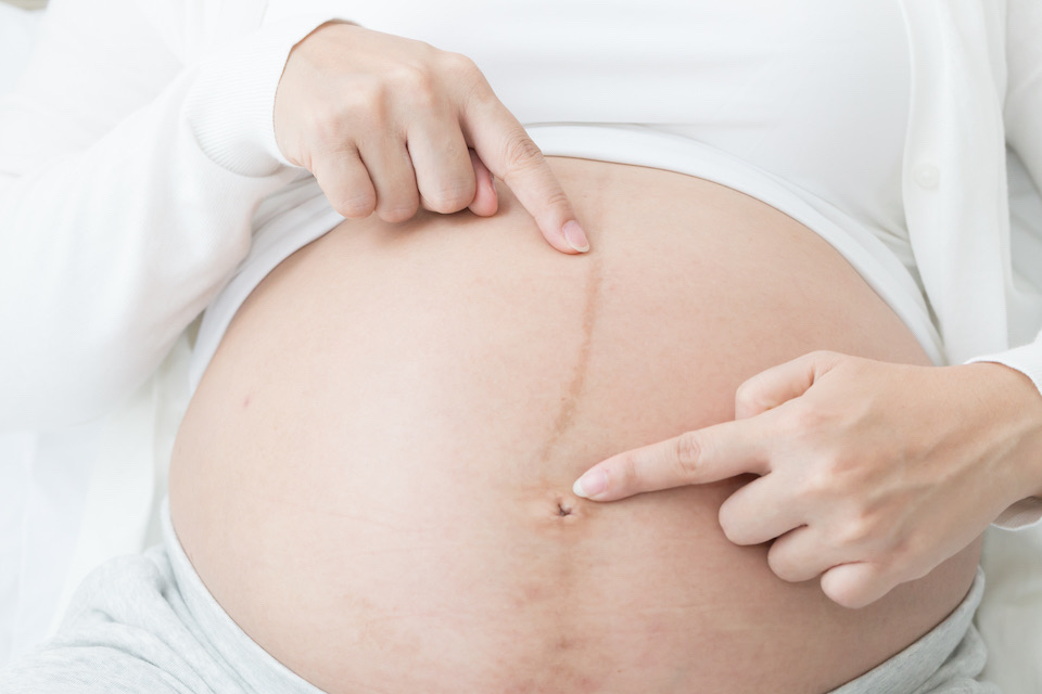 what-is-the-dark-line-on-your-pregnant-belly-soridori